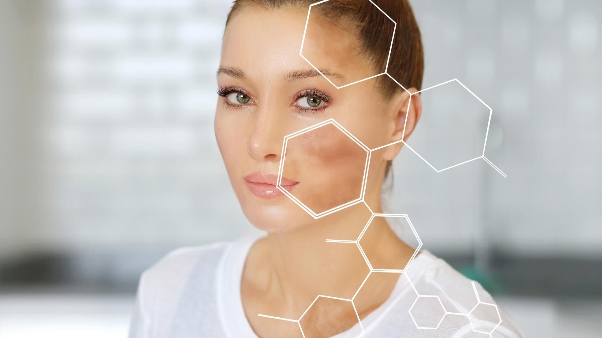 Hyperpigmentation: Effective Treatments for a Balanced Skin Tone