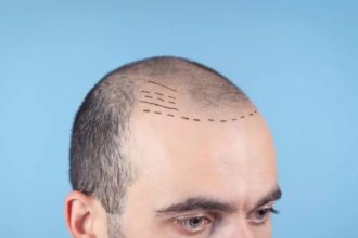 Why Turkey for DHI? Exploring the Top Destination for Hair Transplants