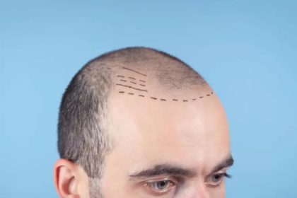 Why Turkey for DHI? Exploring the Top Destination for Hair Transplants